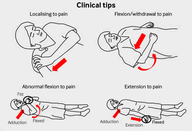 The Nervous System, Reflexes and Krav Maga Part 3 Withdrawing from